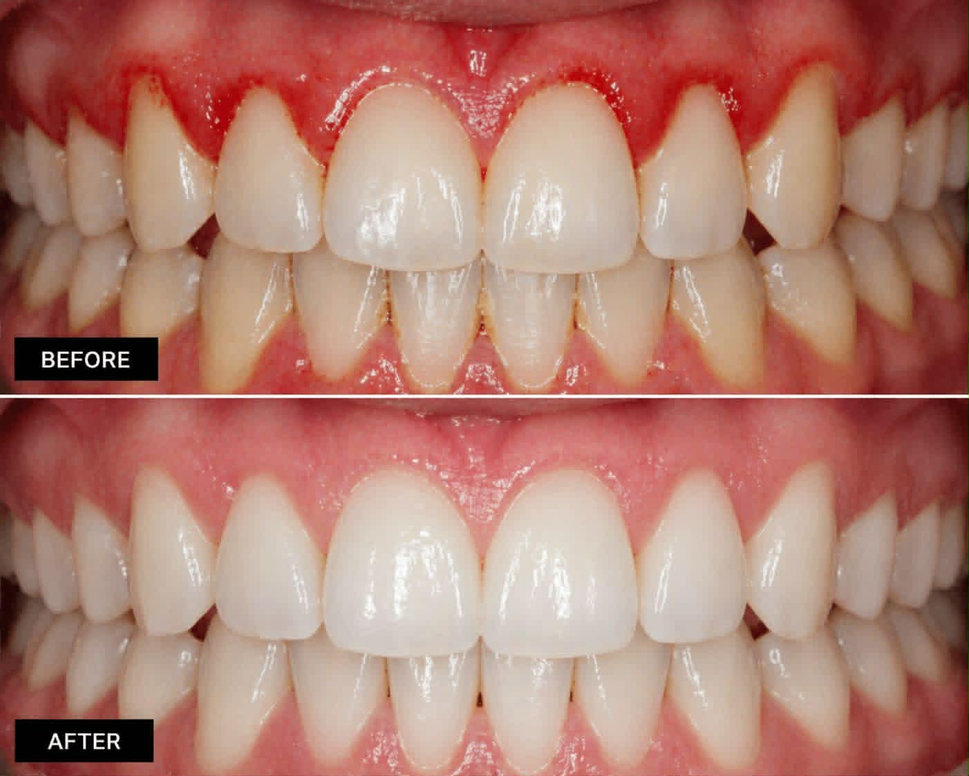Fogínygyulladás kezelés – Tukora Dental